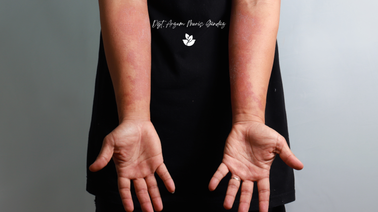 Darıca Diyetisyen Meriç Gündüz ile sağlıklı yaşam ve fiziksel aktivite önerileri. En iyi diyetisyen. Sedef hastalığında beslenme.